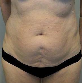 Abdominoplasty Case 5 Before