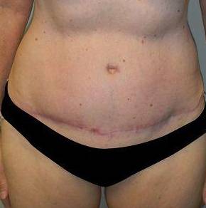 Abdominoplasty Case 5 After