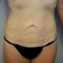 Abdominoplasty Case 6 Before