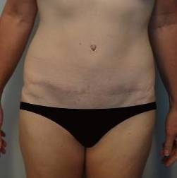Abdominoplasty Case 6 After
