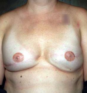 Breast Reconstruction Case 1 After