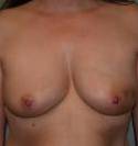 Breast Reconstruction Case 2 Before