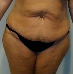 Abdominoplasty Case 7 Before