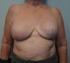 Breast Reconstruction Case 3 After