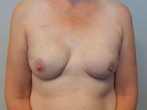 Breast Reconstruction Case 5 After