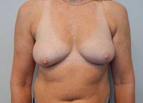Breast Reconstruction Case 6 Before