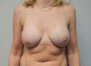 Breast Reconstruction Case 6 After