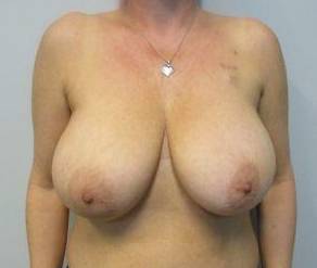 Breast Reconstruction Case 10 Before