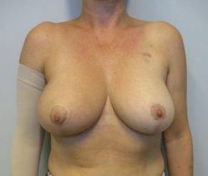Breast Reconstruction Case 10 After