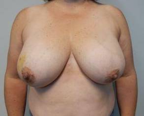 Breast Reconstruction Case 11 Before