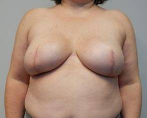 Breast Reconstruction Case 11 After