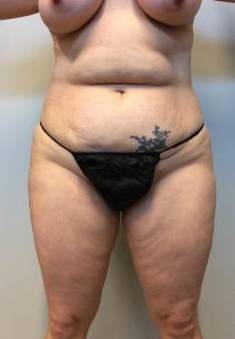 Abdominoplasty Case 9 Before