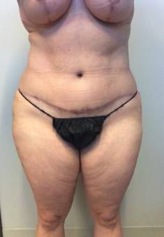 Abdominoplasty Case 9 After