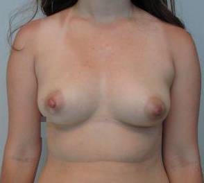 Breast Reconstruction Case 14 Before