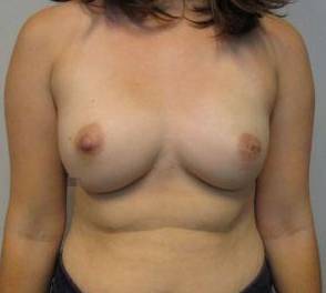 Breast Reconstruction Case 14 After