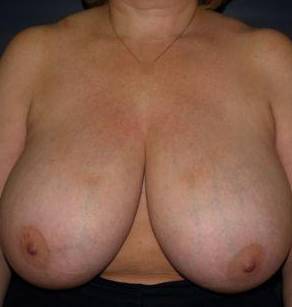 Breast Reduction Case 1 Before