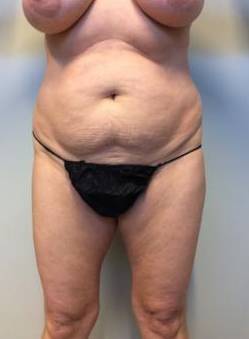 Abdominoplasty Case 10 Before