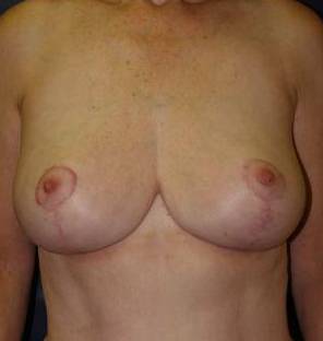 Breast Reduction Case 3 After
