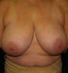 Breast Reduction Case 4 Before