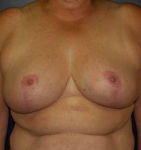 Breast Reduction Case 4 After