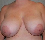 Breast Reduction Case 5 Before