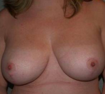 Breast Reduction Case 5 After