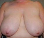 Breast Reduction Case 6 Before