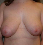Breast Reduction Case 7 Before