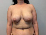 Breast Reduction Case 9 Before