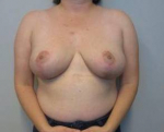 Breast Reduction Case 11 After
