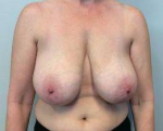 Breast Reduction Case 12 Before