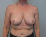 Breast Reduction Case 12 After