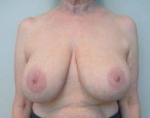 Breast Reduction Case 13 Before