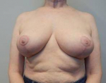 Breast Reduction Case 13 After