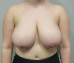 Breast Reduction Case 14 Before