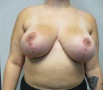 Breast Reduction Case 15 After