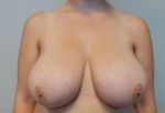 Breast Reduction Case 17 Before