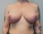 Breast Reduction Case 18 After