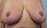 Breast Reduction Case 19 After
