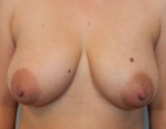 Breast Reduction Case 21 Before