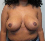 Breast Reduction Case 22 After