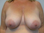 Breast Reduction Case 23 Before