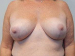 Breast Reduction Case 23 After