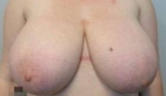 Breast Reduction Case 24 Before