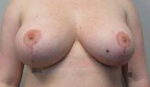Breast Reduction Case 24 After