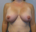 34yo Female Mastopexy w/ Implants After