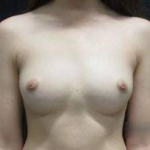 Breast Augmentation Case 46 Before