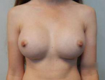 Breast Augmentation Case 46 After