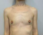 Breast Augmentation Case 47 Before
