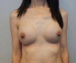 Breast Augmentation Case 47 After